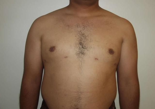 Liposuction after at Dr. Ron Soltero FACS in San Diego, CA