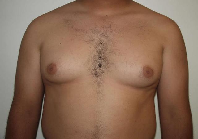 Liposuction before at Dr. Ron Soltero FACS in San Diego, CA