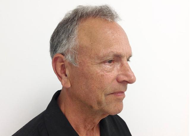 Facelift after at Dr. Ron Soltero FACS in San Diego, CA