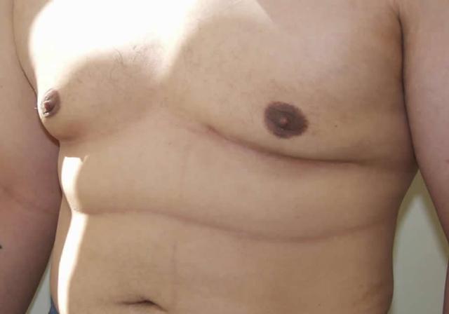 Gynecomastia Surgery after at Dr. Ron Soltero FACS in San Diego, CA
