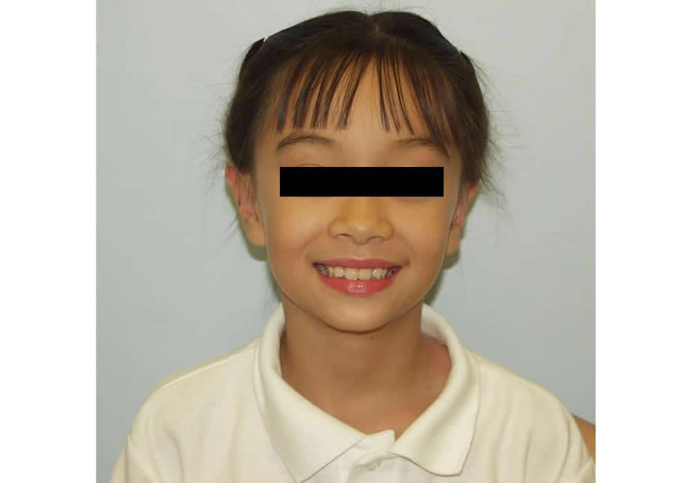Dr. Ron Soltero FACS otoplasty after — San Diego, CA