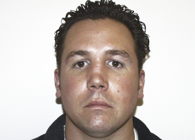 Rhinoplasty before at Dr. Ron Soltero FACS in San Diego, CA