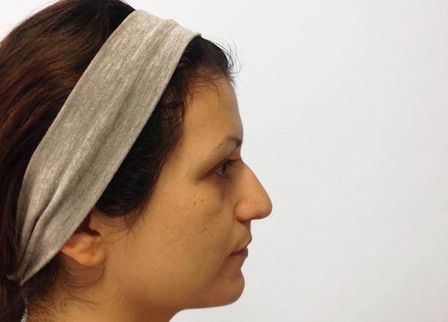 Functional Rhinoplasty before at Dr. Ron Soltero FACS in San Diego, CA
