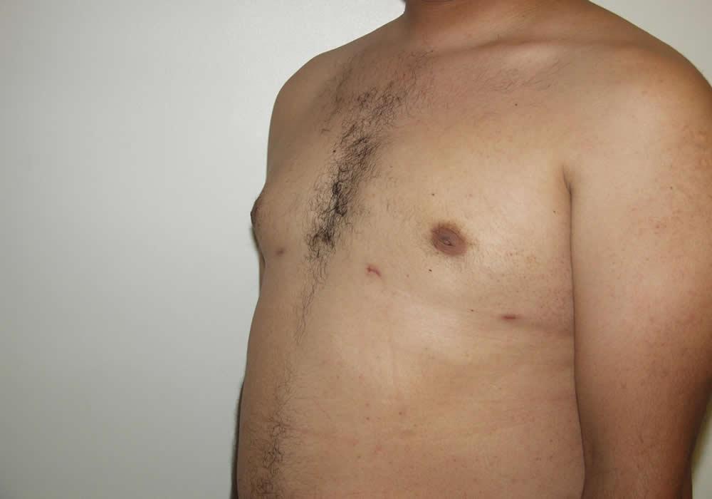Dr. Ron Soltero FACS liposuction after — San Diego, CA