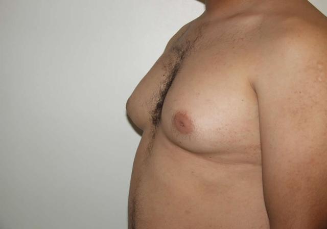 Liposuction before at Dr. Ron Soltero FACS in San Diego, CA