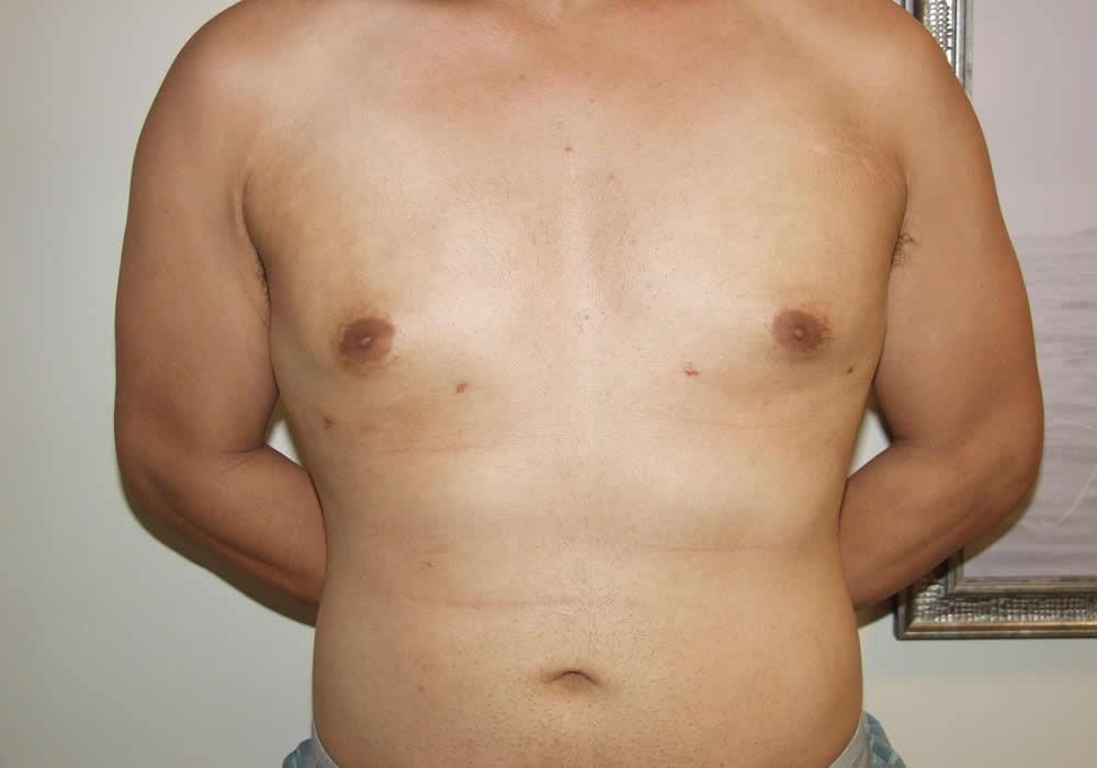 Dr. Ron Soltero FACS gynecomastia after — San Diego, CA
