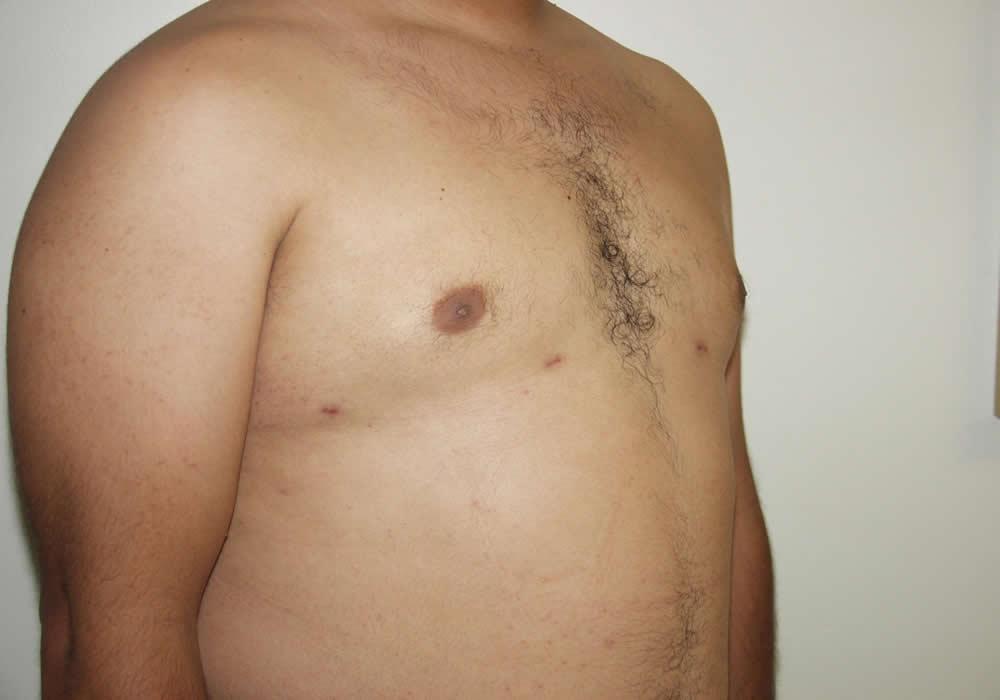 Dr. Ron Soltero FACS liposuction after — San Diego, CA