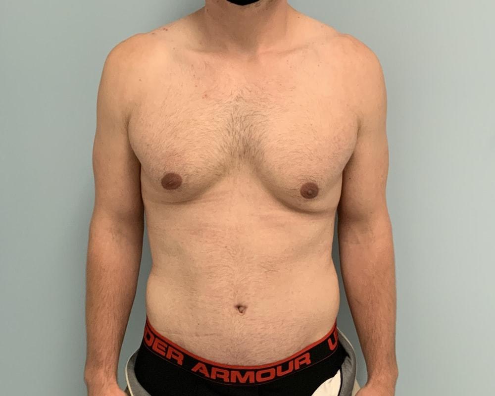 Dr. Ron Soltero FACS tummy tuck after — San Diego, CA