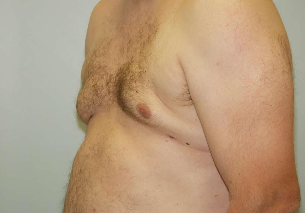 Dr. Ron Soltero FACS gynecomastia after — San Diego, CA