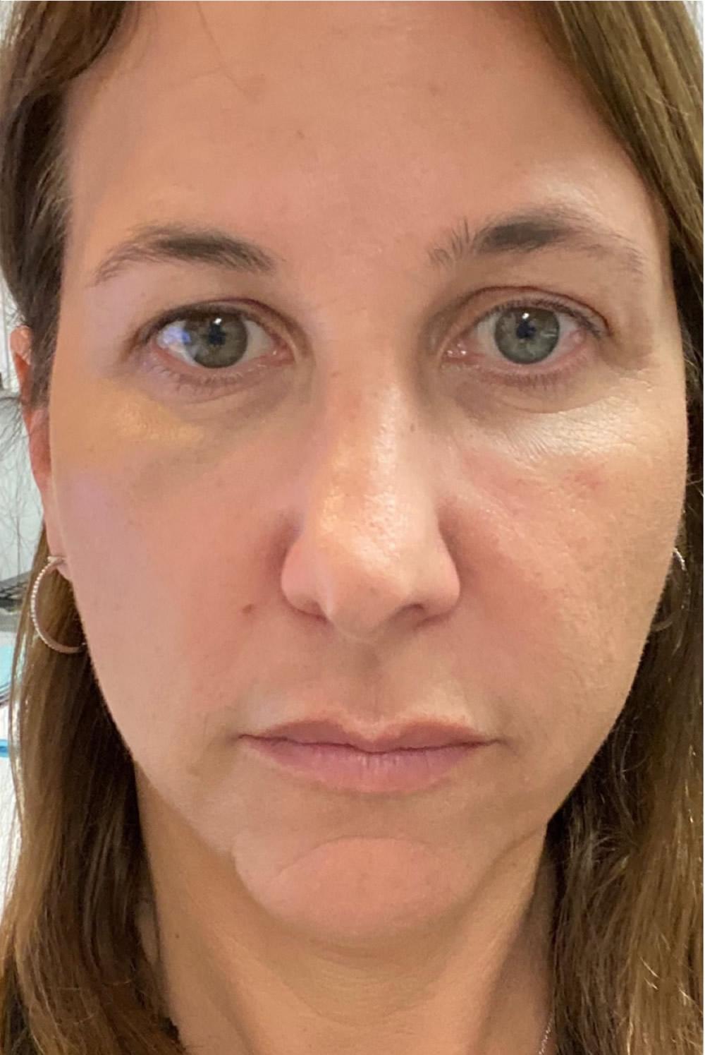 Dr. Ron Soltero FACS after — San Diego, CA