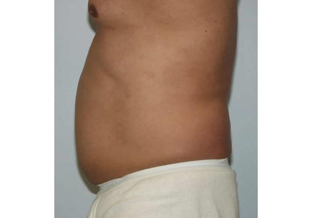 Liposuction before at Dr. Ron Soltero FACS in San Diego, CA