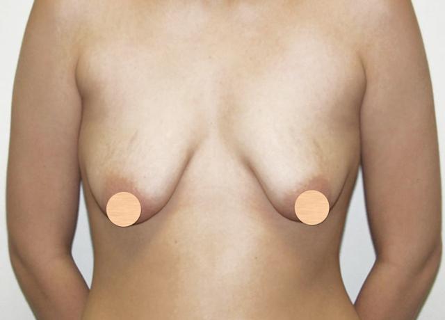 Fat Transfer Breast Augmentation before at Dr. Ron Soltero FACS in San Diego, CA
