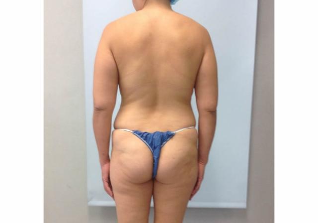 Brazilian Butt Lift before at Dr. Ron Soltero FACS in San Diego, CA