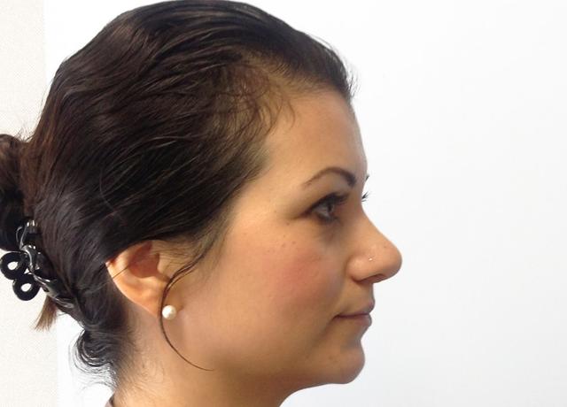 Functional Rhinoplasty after at Dr. Ron Soltero FACS in San Diego, CA
