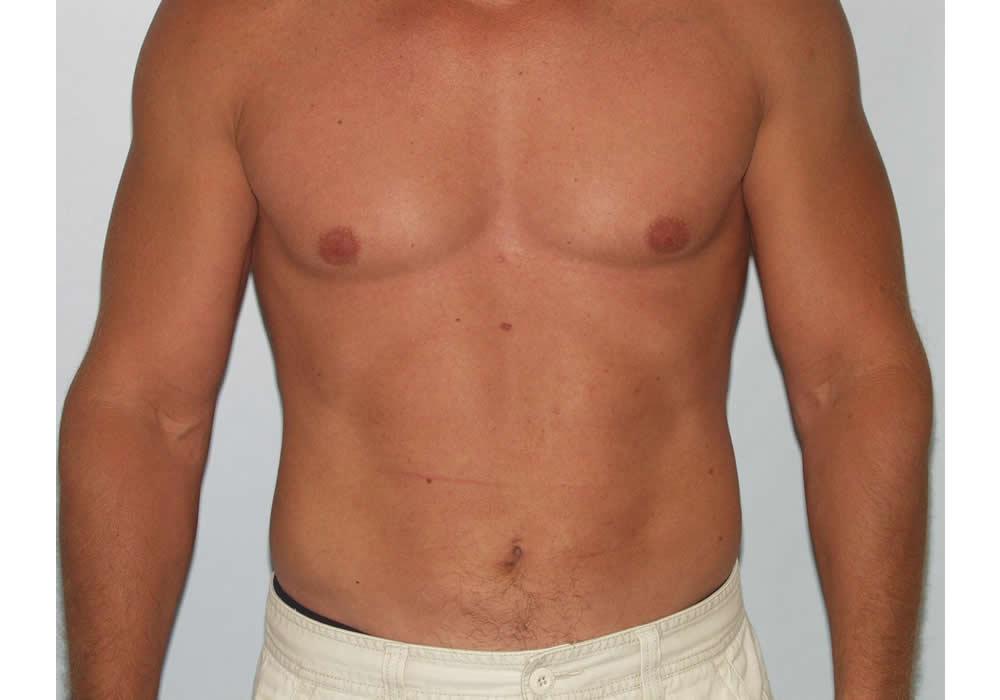 Dr. Ron Soltero FACS liposuction after — San Diego, CA