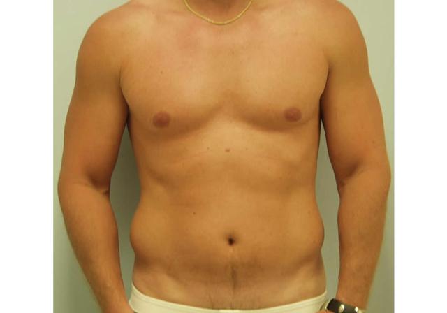 Liposuction before at Dr. Ron Soltero FACS in San Diego, CA