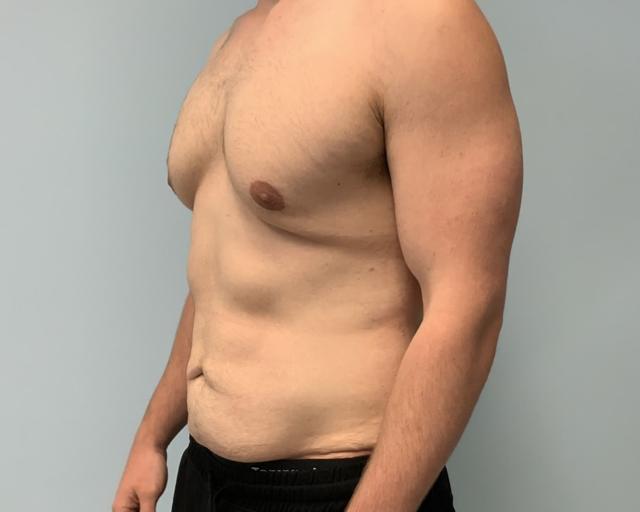Mini Tummy Tuck before at Dr. Ron Soltero FACS in San Diego, CA