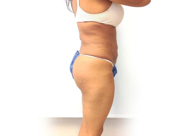 Brazilian Butt Lift after at Dr. Ron Soltero FACS in San Diego, CA