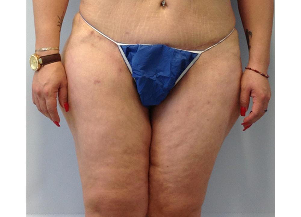 Dr. Ron Soltero FACS thigh lift after — San Diego, CA