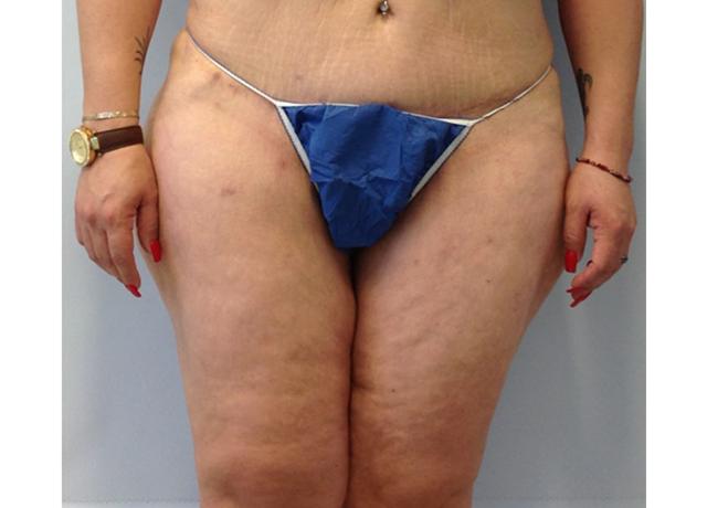 Thigh Lift after at Dr. Ron Soltero FACS in San Diego, CA