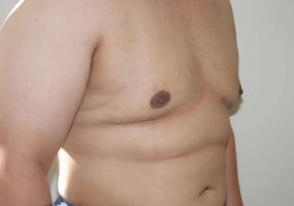 Dr. Ron Soltero FACS gynecomastia after — San Diego, CA