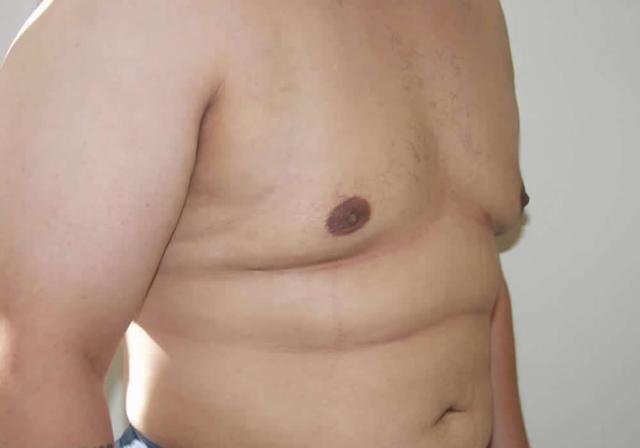 Gynecomastia Surgery after at Dr. Ron Soltero FACS in San Diego, CA