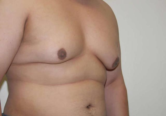 Gynecomastia Surgery before at Dr. Ron Soltero FACS in San Diego, CA