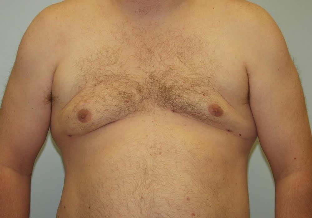 Dr. Ron Soltero FACS gynecomastia after — San Diego, CA
