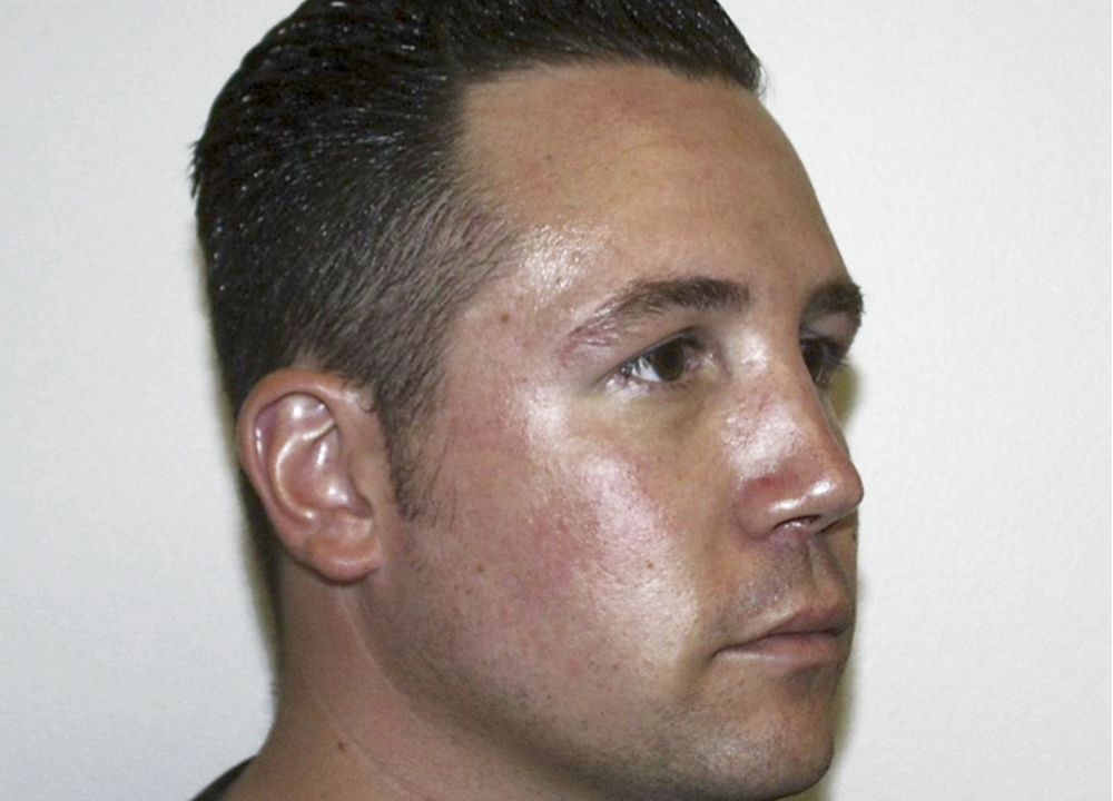 Dr. Ron Soltero FACS after — San Diego, CA