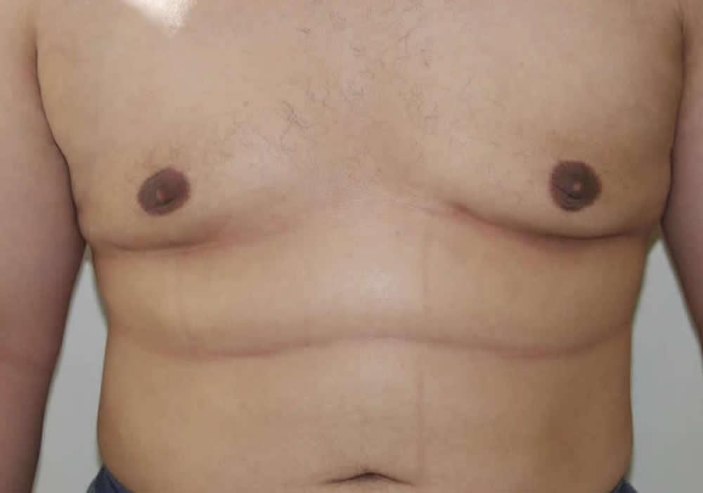 Dr. Ron Soltero FACS gynecomastia after — San Diego, CA
