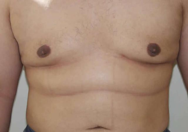 Gynecomastia Surgery after at Dr. Ron Soltero FACS in San Diego, CA