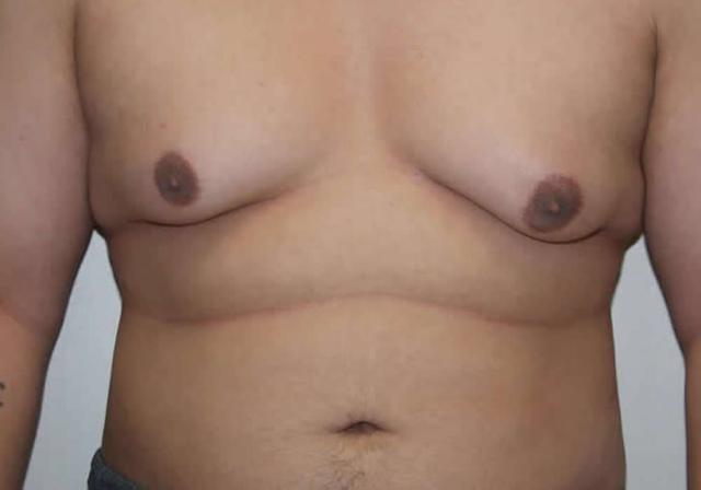 Gynecomastia Surgery before at Dr. Ron Soltero FACS in San Diego, CA