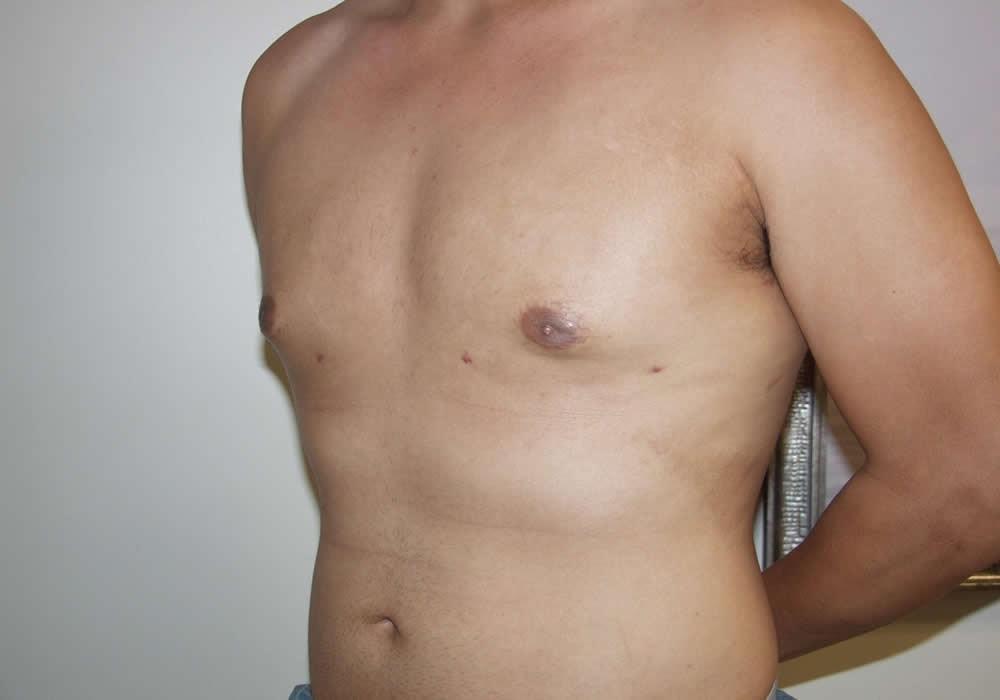 Dr. Ron Soltero FACS gynecomastia after — San Diego, CA