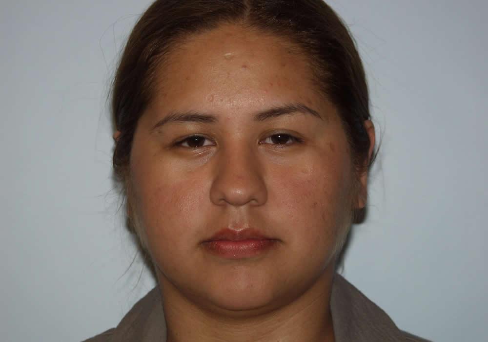 Dr. Ron Soltero FACS otoplasty after — San Diego, CA