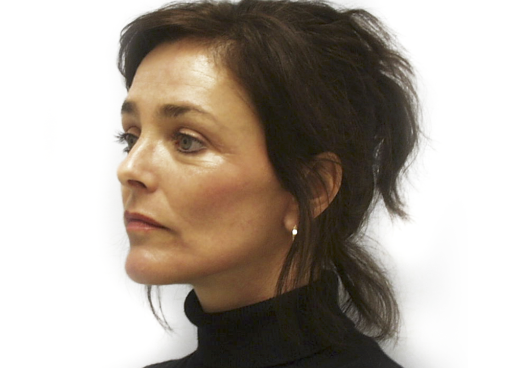 Dr. Ron Soltero FACS after — San Diego, CA