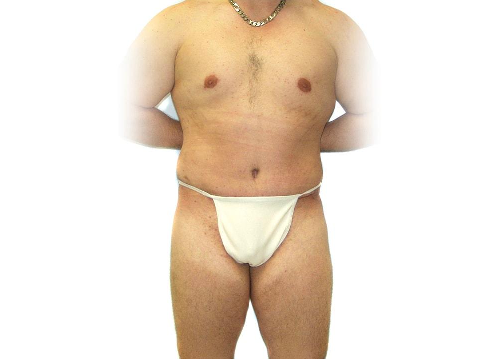 Dr. Ron Soltero FACS tummy tuck after — San Diego, CA
