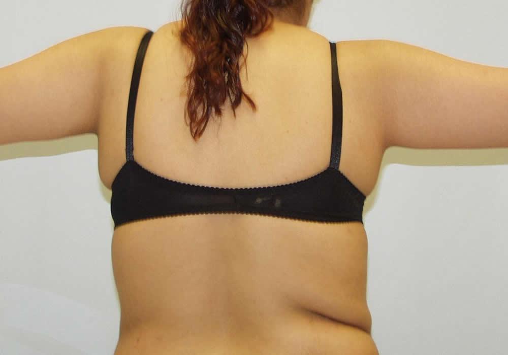 Dr. Ron Soltero FACS arm lift after — San Diego, CA