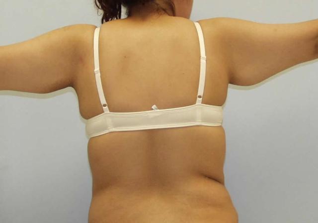CoolSculpting before at Dr. Ron Soltero FACS in San Diego, CA