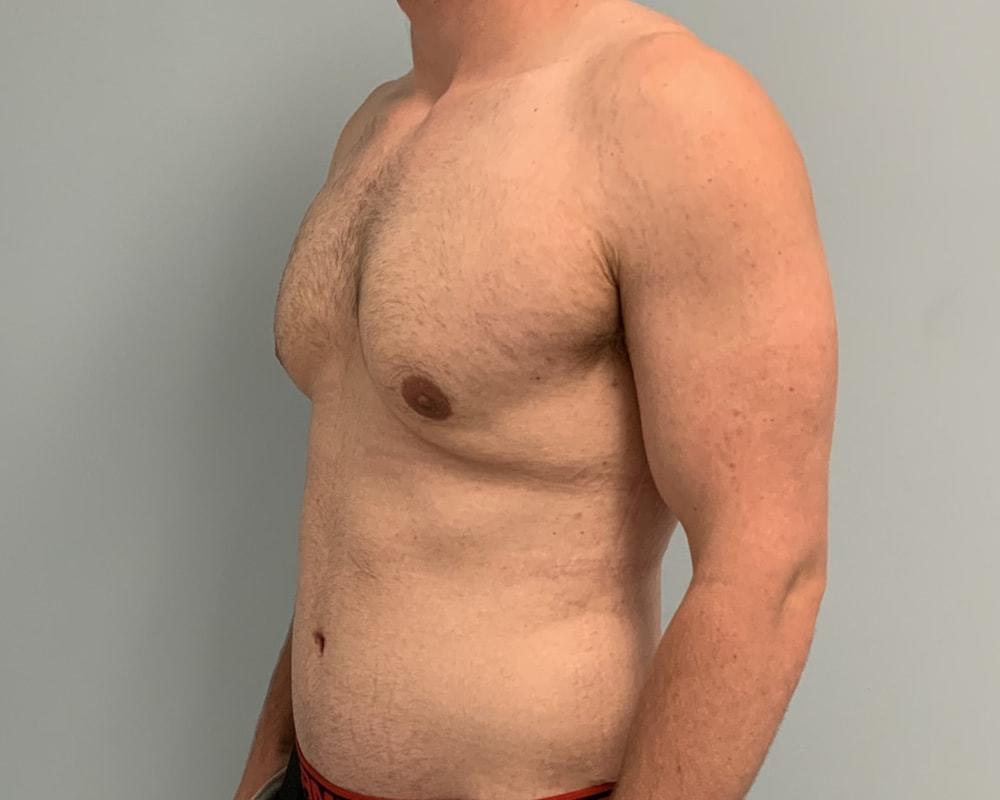Dr. Ron Soltero FACS tummy tuck after — San Diego, CA