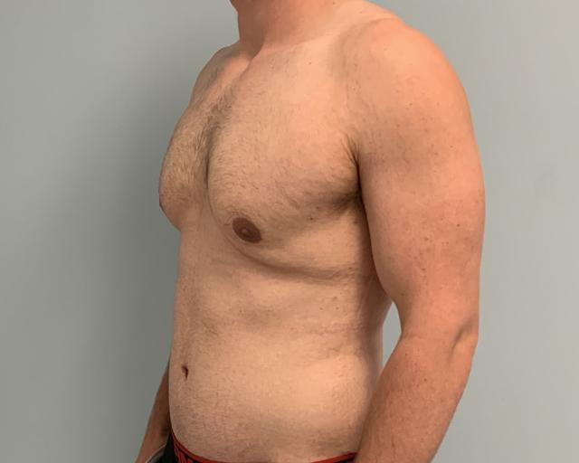 Mini Tummy Tuck after at Dr. Ron Soltero FACS in San Diego, CA