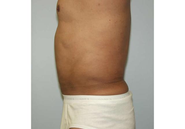 Liposuction after at Dr. Ron Soltero FACS in San Diego, CA