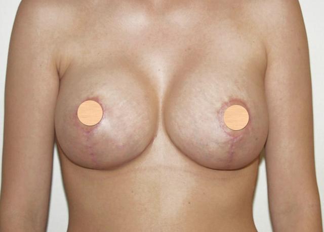 Fat Transfer Breast Augmentation after at Dr. Ron Soltero FACS in San Diego, CA