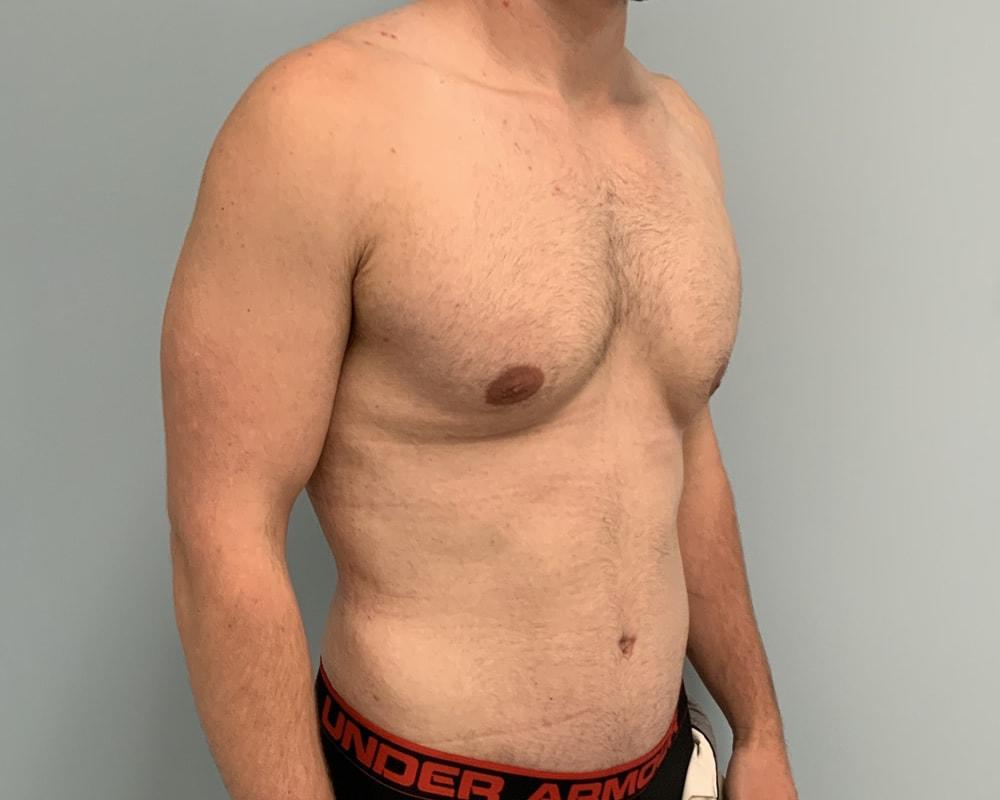 Dr. Ron Soltero FACS tummy tuck after — San Diego, CA