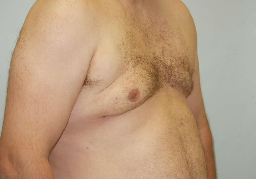 Dr. Ron Soltero FACS gynecomastia after — San Diego, CA