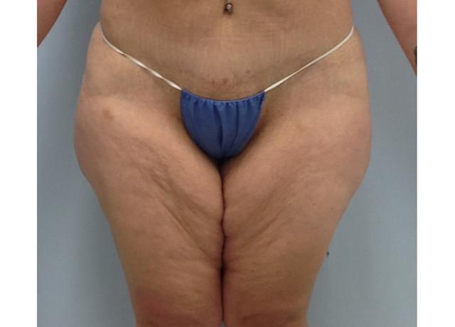 Thigh Lift before at Dr. Ron Soltero FACS in San Diego, CA