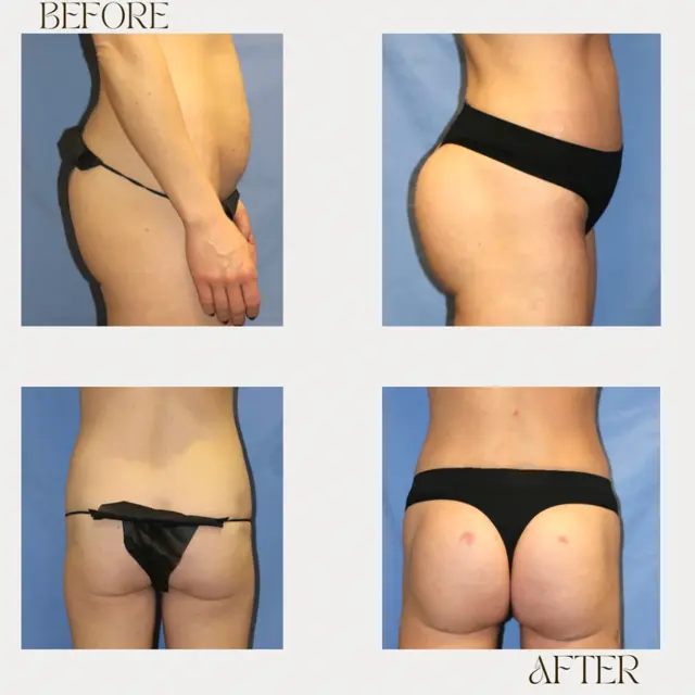 Brazilian Butt Lift result at Ashby Plastic Surgery & Aesthetics: Eric R Ashby MD in Layton, UT