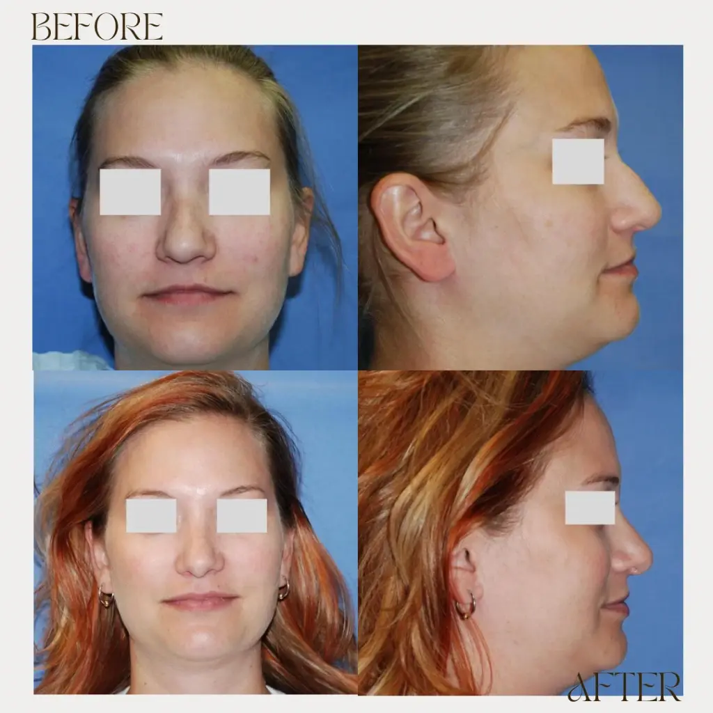 Ashby Plastic Surgery & Aesthetics: Eric R Ashby MD rhinoplasty result — Layton, UT