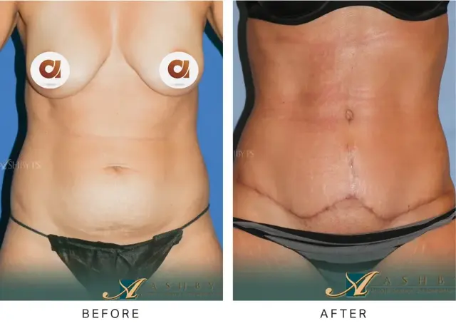 Mini Tummy Tuck result at Ashby Plastic Surgery & Aesthetics: Eric R Ashby MD in Layton, UT