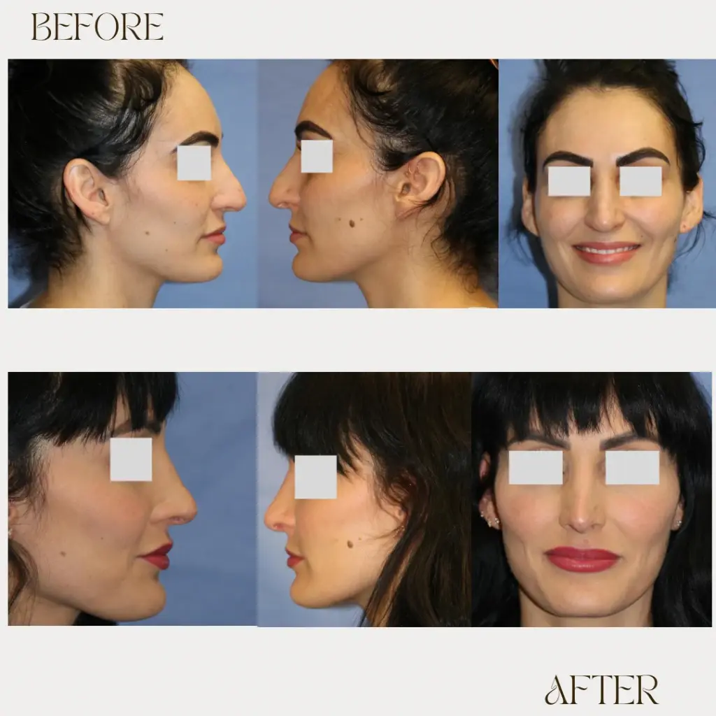 Ashby Plastic Surgery & Aesthetics: Eric R Ashby MD rhinoplasty result — Layton, UT