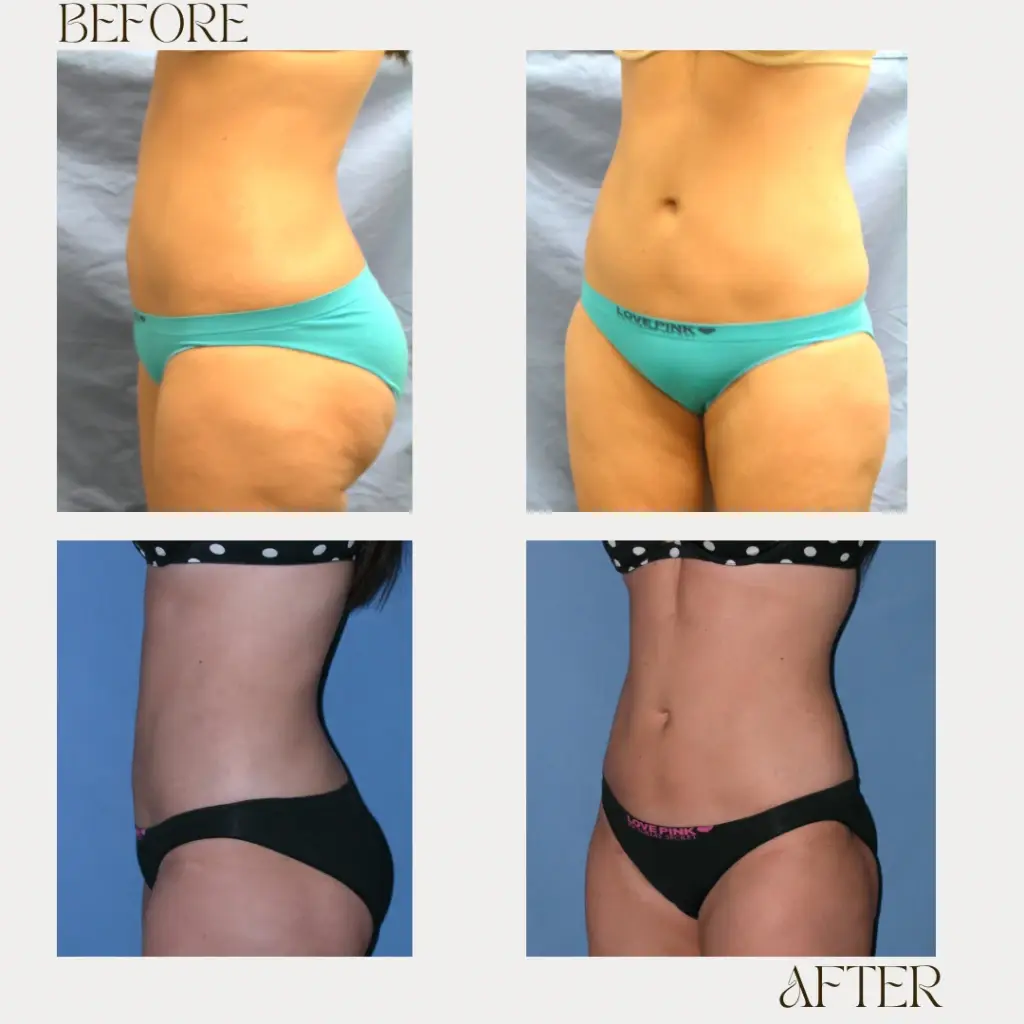 Ashby Plastic Surgery & Aesthetics: Eric R Ashby MD liposuction result — Layton, UT